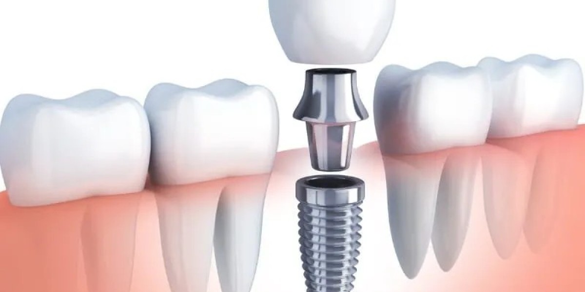 Comprehensive Bone Grafting Solutions in McKinney, Texas: Restoring Jaw Structure and Dental Function
